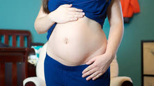 1 week postpartum belly c section