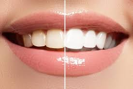 can teeth whitening kit be trusted