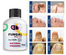 daktarin tincture for fungal nail infec