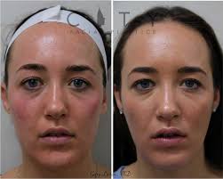 nyc fillers dermal injections
