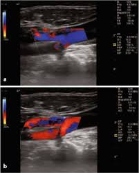 errors in color doppler ultrasonography