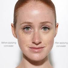 cure your redheaded under eye dark circles