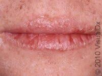 cheilitis causes treatment and