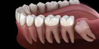Most people get their wisdom teeth removed between 17 and 25 years of age. After Wisdom Teeth Removal Oral Surgeon Attleboro Falls Ma