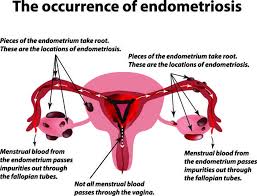 Multiple studies suggest arid1a mutation occurs at early stage of canceration of endometriosis (oncol rep 2016;35:607) Endometriosis Nevada Center For Reproductive Medicine
