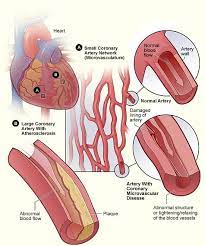 coronary disease causes and