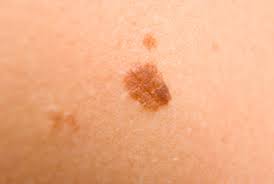 What Are The Symptoms Of Skin Cancer Cdc