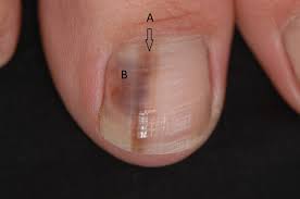 melanoma of the foot and nail unit