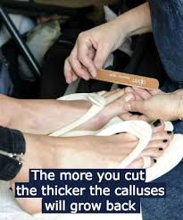you don t need your calluses removed