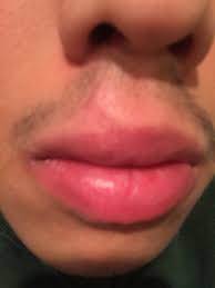 get rid of a lip laceration scar