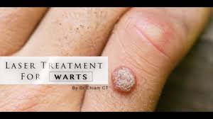 warts removal with laser treatment dr