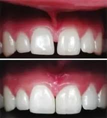 Not so complex gaps between the teeth can be a tooth colored resin is reshaped to bond with your existing teeth in order to fill out the gaps. What Is The Procedure To Decrease A Gap Between The Front Two Teeth Quora
