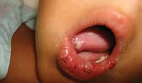 a mucositis lesions on lower lip