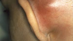 what causes lumps behind the ears