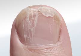 toenail conditions relieve foot pain