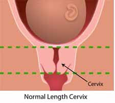 short cervix in pregnancy
