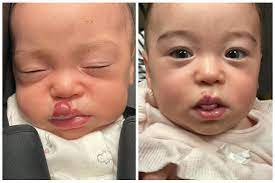 hemangiomas before and after photos