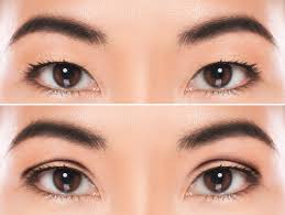asian blepharoplasty double eyelid