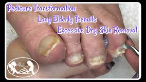 dry skin from elderly toenails and feet