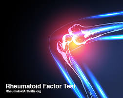 Rf Test What Is The Normal Range For A Rheumatoid Factor