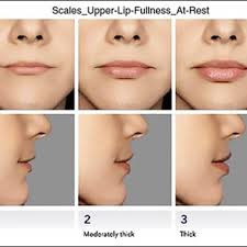 lips augmentation with hyaluronic acid