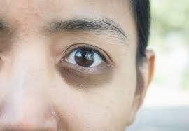 dark eye circles treatment