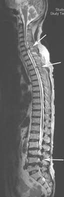 tandem spinal stenosis neurosurgery