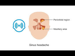 diagnosing sinus headaches you