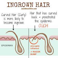 tips for preventing ingrown hairs