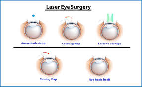 lasik surgery indore rajas eye