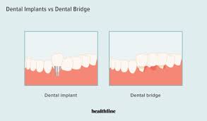 dental implant vs bridge pros cons