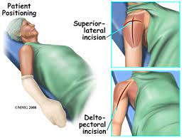 reverse shoulder arthroplasty