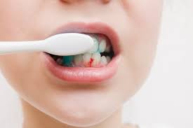 gums bleeding while brushing or
