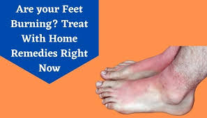 home remes for burning feet treat