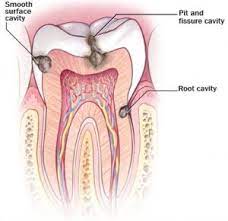 A worn toothbrush won't do a good job of cleaning your teeth. Tooth Decay Cavities Can Be Repaired With Dental Fillings