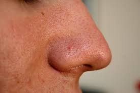 Image result for blackheads on nose