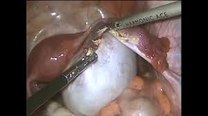 large ovarian cyst 10cm