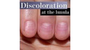 Check spelling or type a new query. What Nails Discolored At The Moons Mean Nailpro