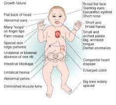 It is often seen as a normal finding in very young children and is also common in people of asiatic decent. Down Syndrome Trisomy 21 Physiopedia