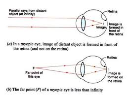 Defects Of Vision And Their Correction Class 10 The Human