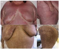 The generalized form of ga, which accounts for. A Case Of Generalized Interstitial Granuloma Annulare And Arthritis Associated With Breast Cancer Html Acta Dermato Venereologica