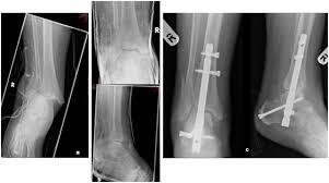 fragility fractures of the ankle in the