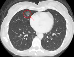 Cureus Extraintestinal Manifestations