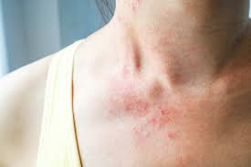 30 common skin rash pictures how to