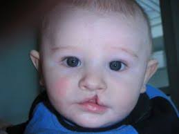 cleft lip and cleft palate causes