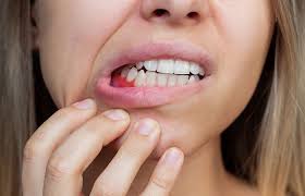 15 home remes for swollen gums and