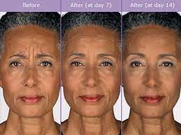 botox before after photos wrinkle