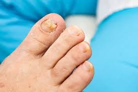 counter treatments for onychomycosis