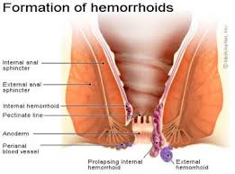 Hemorrhoids Background Anatomy Etiology And Pathophysiology