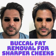 cheek buccal fat removal best
